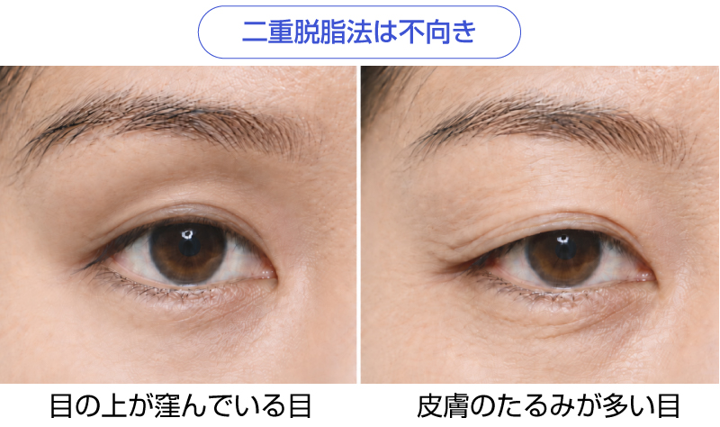 目の上が窪んでいる目と皮膚のたるみが多い目