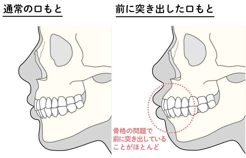 通常の口もと・前に突き出した口もと