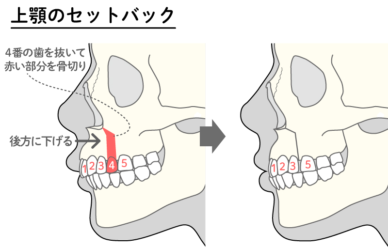 上顎のセットバック