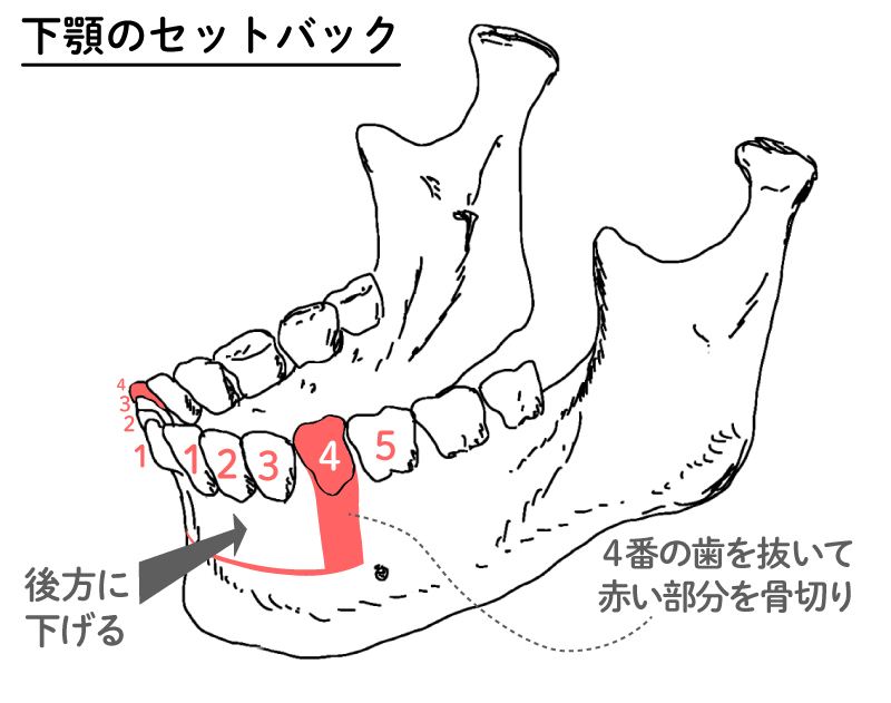 下顎のセットバック