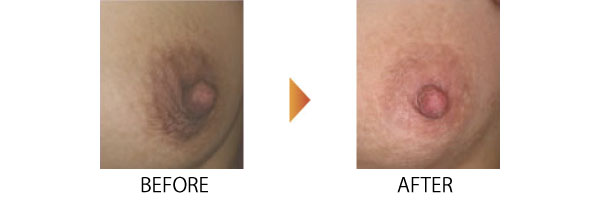 トレチノイン オートトランスレチノン酸 大阪 女性特有の悩み 症例