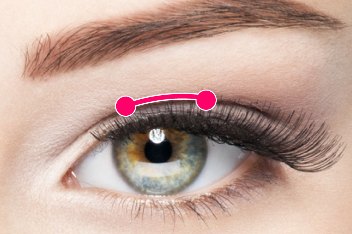 二重 整形 埋没 ブリッジ法 プチ整形 大阪