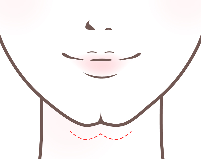 割れアゴ（ケツアゴ）イメージ