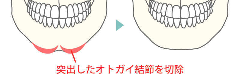 オトガイ結節部骨切り術イメージ