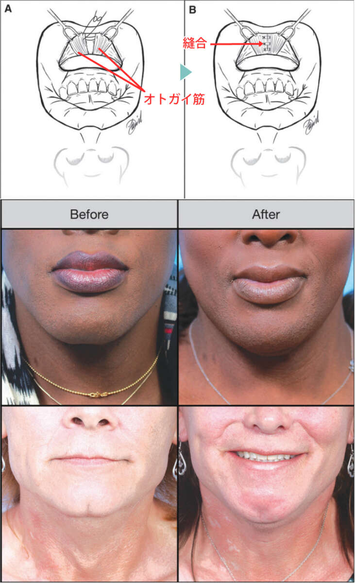 オトガイ筋重層形成術イメージ