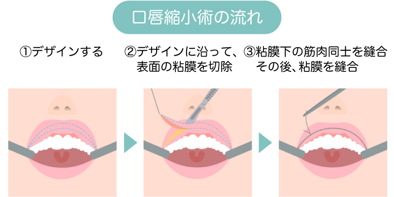 施術の流れ