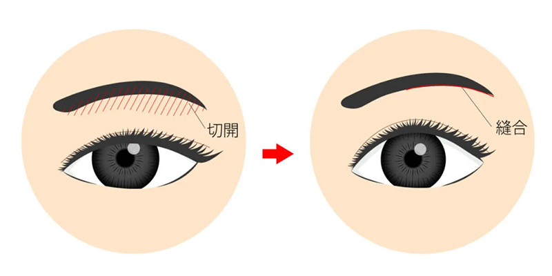 眉下切開で余った上まぶたの皮膚を調整するイメージ