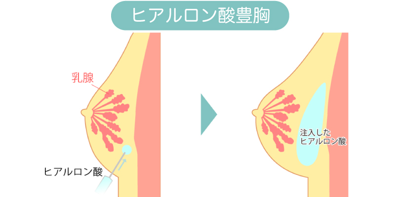 ヒアルロン酸豊胸