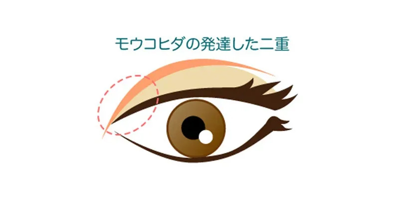 二重まぶたができる仕組みを解説するイメージ