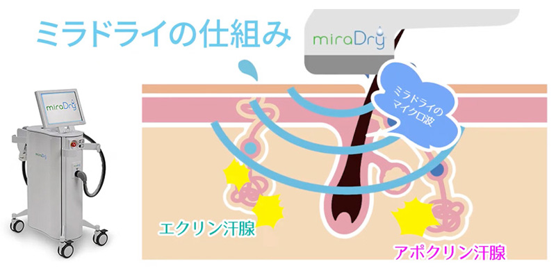 ミラドライで行うわきが治療のイメージ