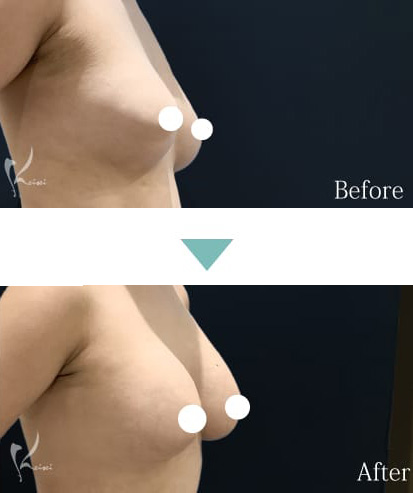 脂肪注入豊胸術のBeforeとAfter