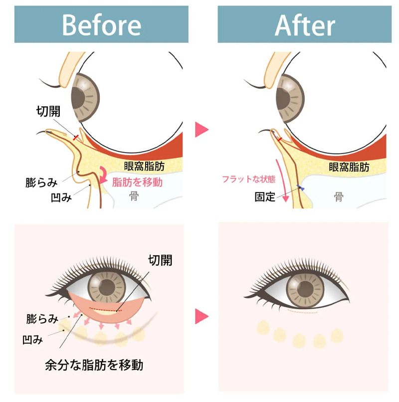 裏ハムラ法の治療イメージ