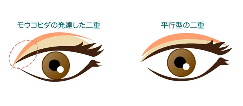 目頭切開で蒙古ひだを調整する仕組みを解説するイメージ