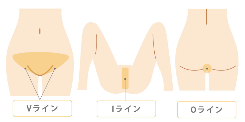 VIOイメージ