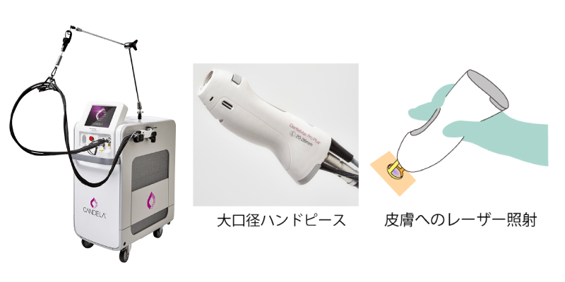 医療レーザー脱毛器イメージ