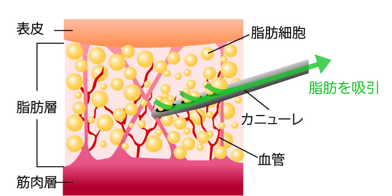 脂肪吸引の仕組みを説明するイメージ