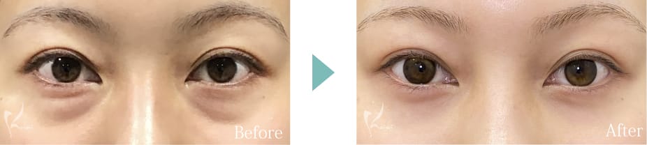 目の下脱脂法のBeforeとAfter