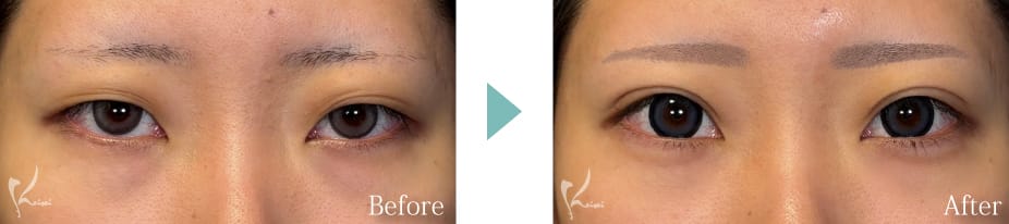 目の下脱脂法のBeforeとAfter