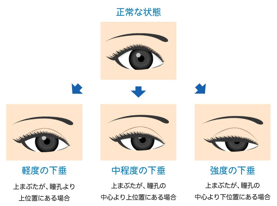 埋没法と切開法による二重整形修正のイメージ