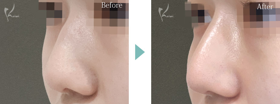 鷲鼻治療のBeforeとAfter