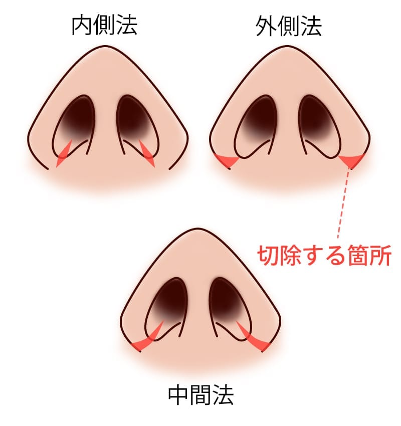 小鼻縮小の内側法と外側法の違いを説明するイメージ