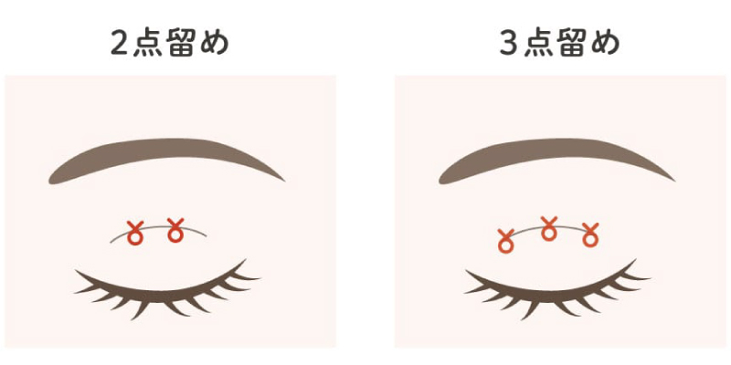 点留めイメージ