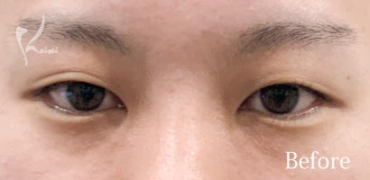 Before写真