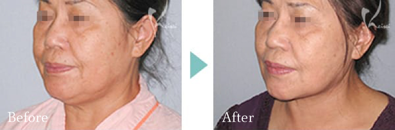 クイーンリフト＋アゴの脂肪吸引のBeforeとAfter