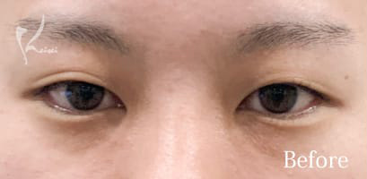 Before写真