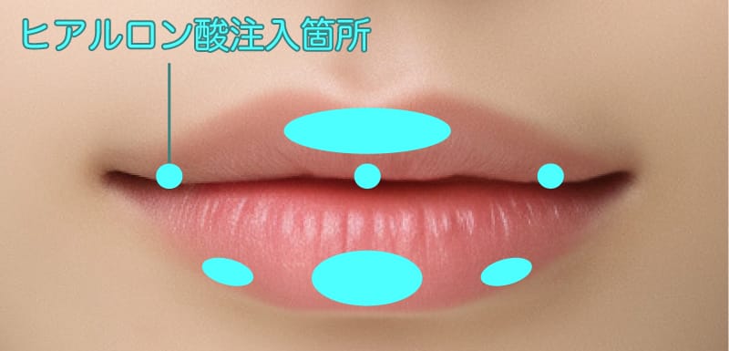 唇の厚みや輪郭を整えるヒアルロン酸注入の注入箇所のイメージ