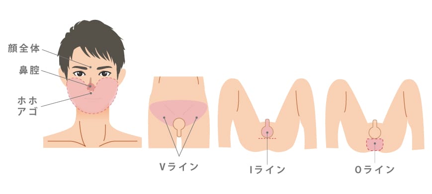 VIOの男性脱毛部位を確認するイメージ