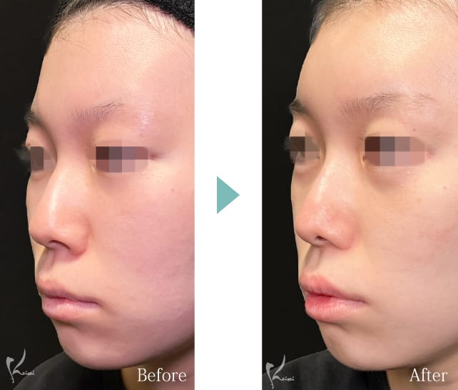 斜めから見たBeforeとAFTER写真