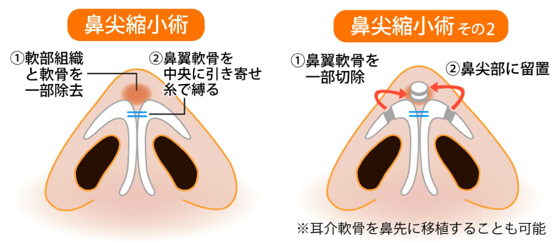 切らない鼻尖形成の手術概要