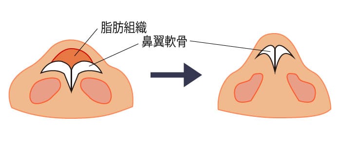 鼻尖形成と鼻尖縮小の違いを示す鼻先のイメージ