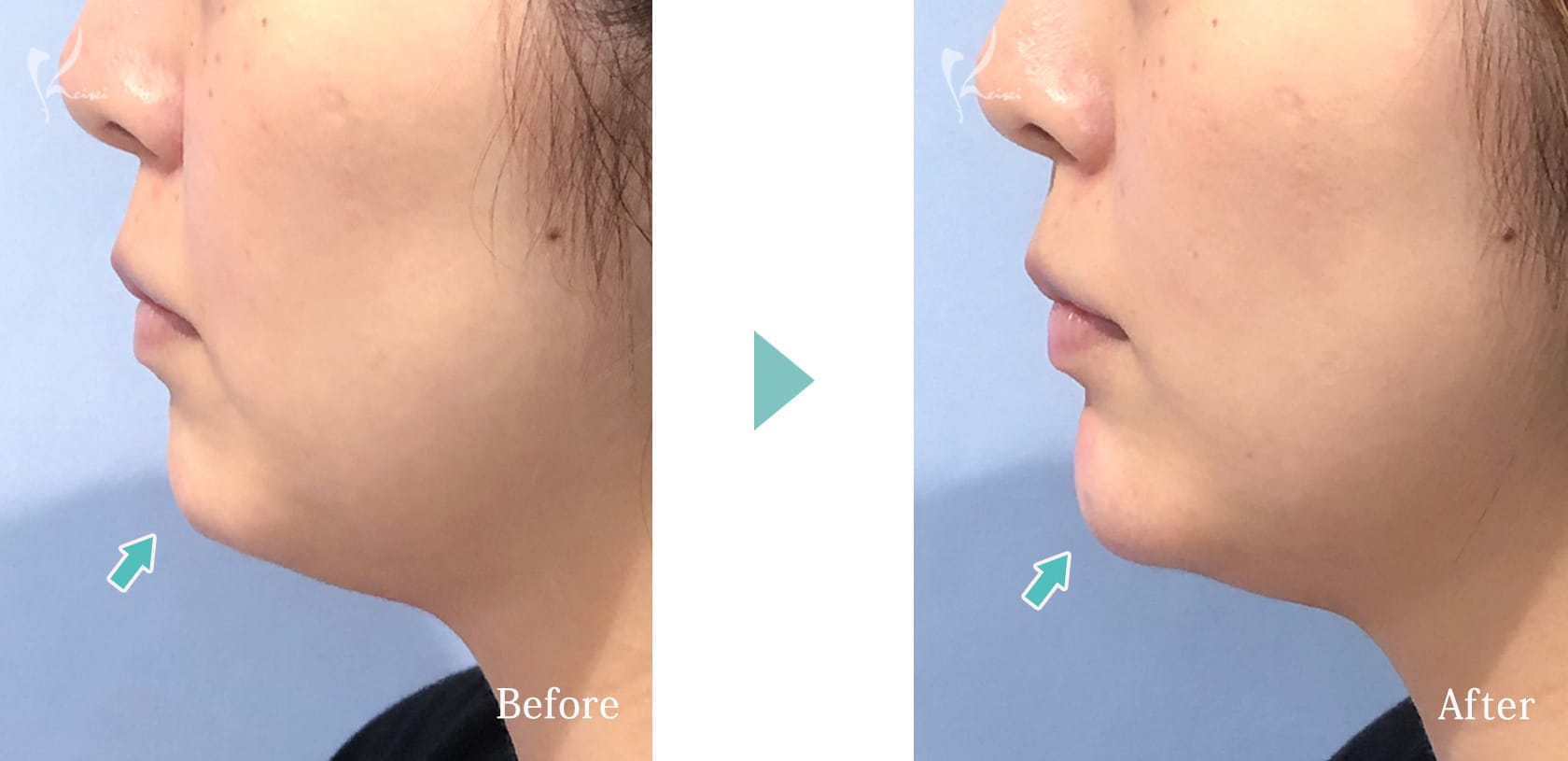 BEFOREとAFTERの写真