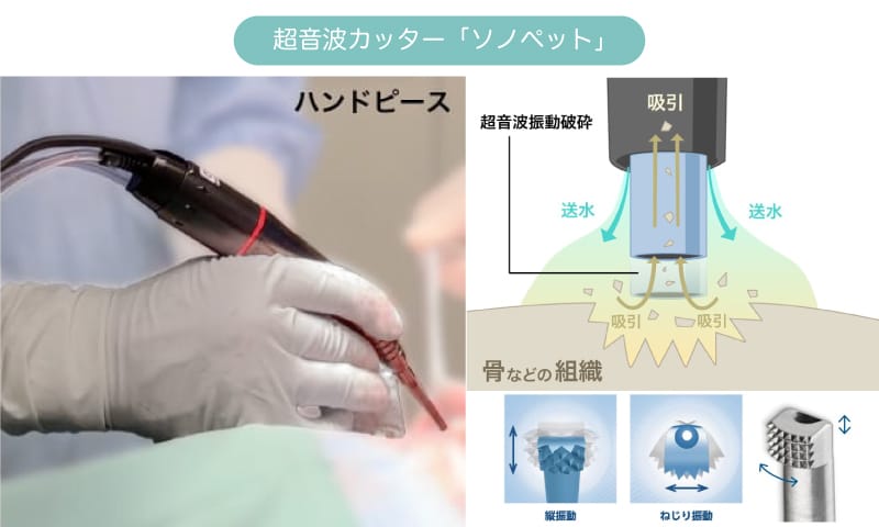 超音波カッターを用いた頬骨切りのイメージ