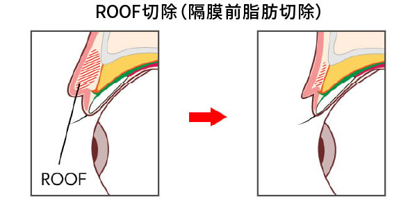 ROOF切除の方法