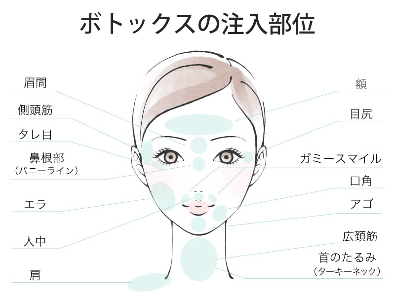 ボトックスの効果期間を左右する注入部位と筋肉