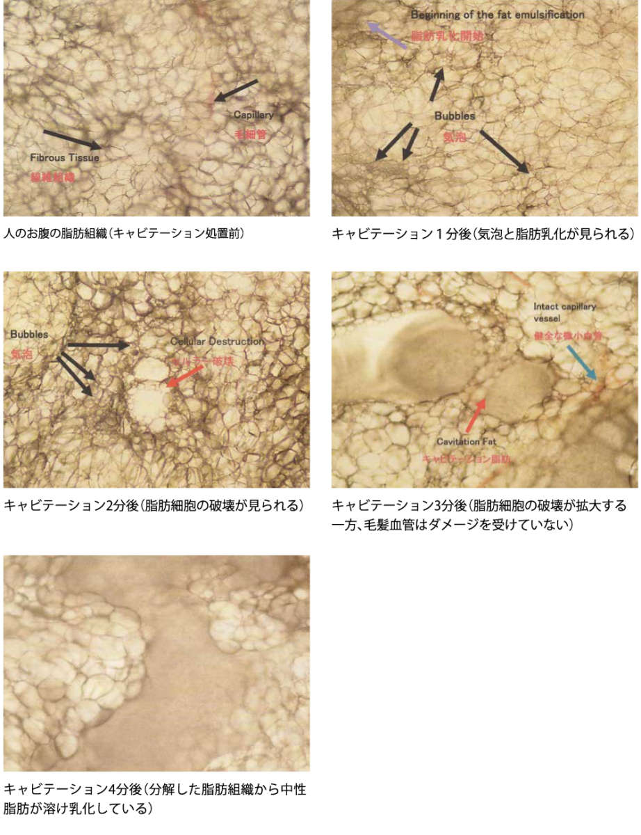 キャビテーションが皮下脂肪へ作用する仕組み