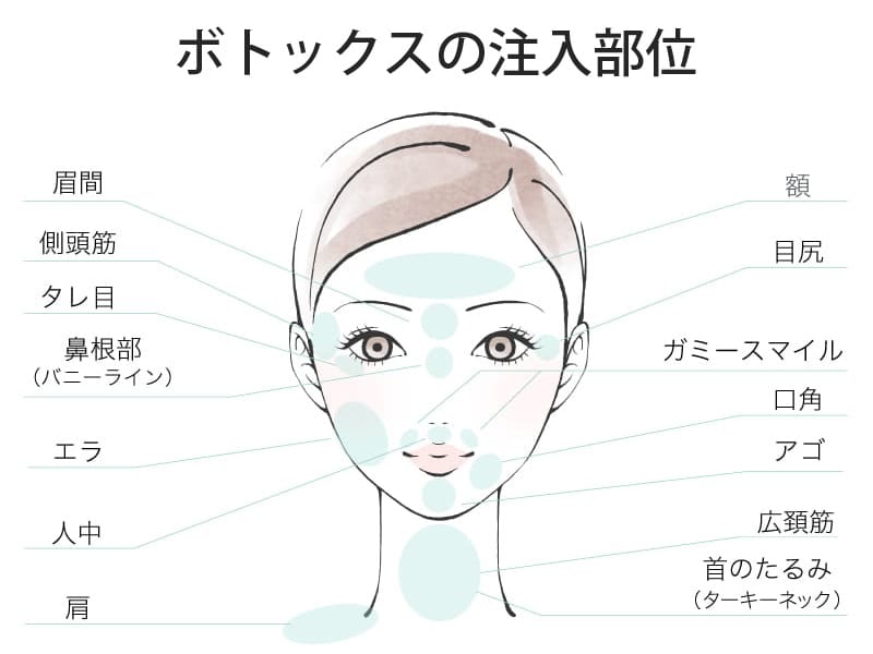 ボツリヌストキシンが神経から筋肉への信号を弱める仕組み