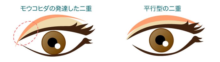 目頭切開で蒙古ひだを調整するイメージ