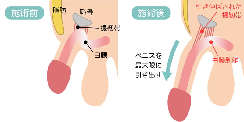 長茎手術のBEFOREとAFTERのイメージ