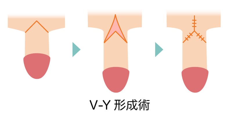 V-Y形成術のイメージ