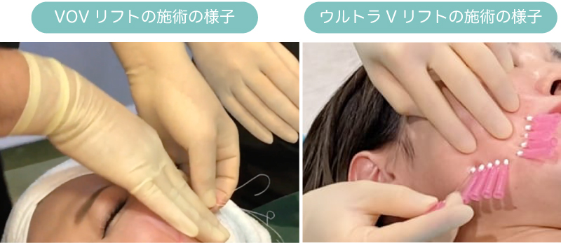 施術の様子