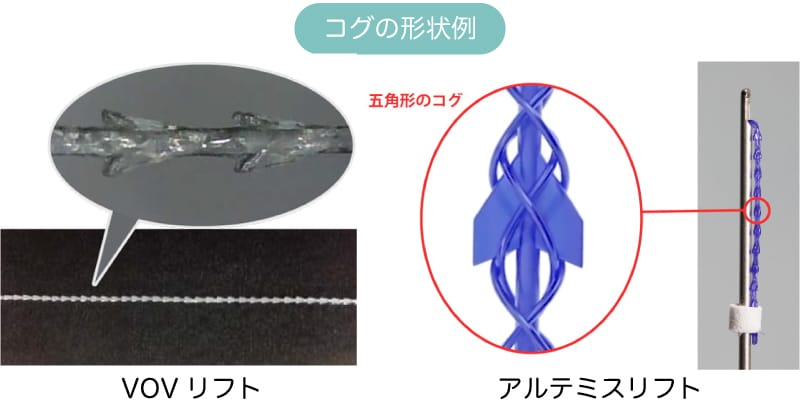 糸リフトでフェイスラインを引き上げるイメージ