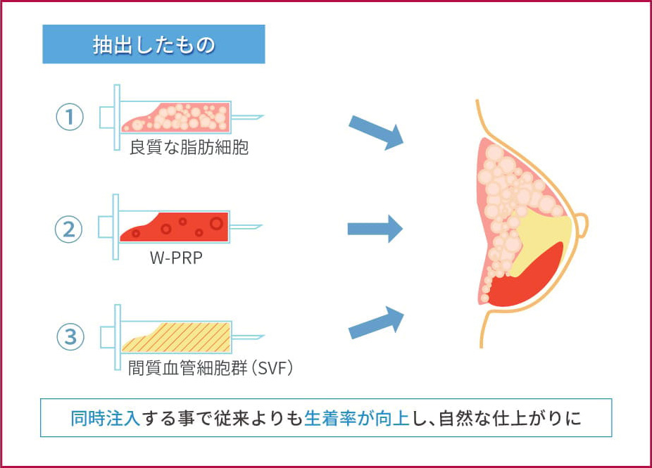 脂肪注入豊胸で胸に脂肪を注入するイメージ