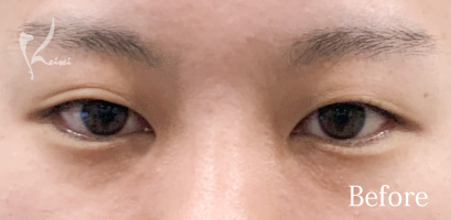 Before写真