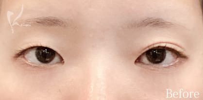 Before写真