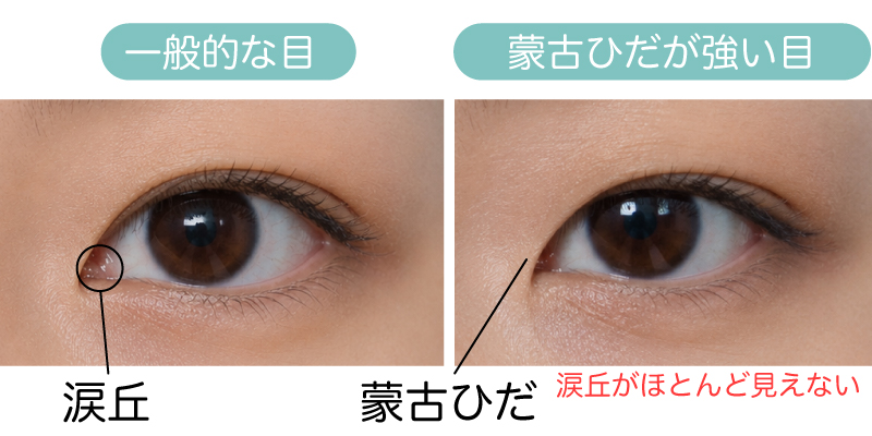 蒙古ひだが強い状態のイメージ