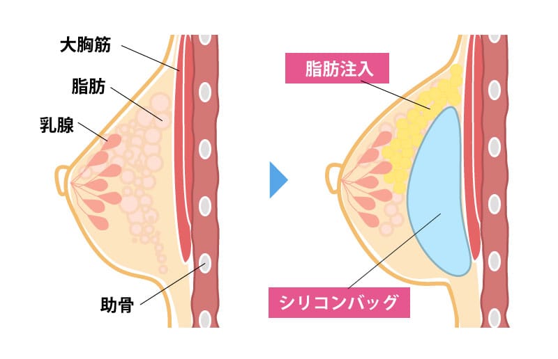 ハイブリッド豊胸解説